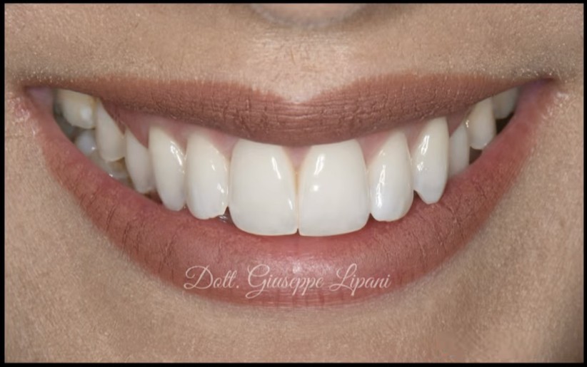 Avant / Après — avant