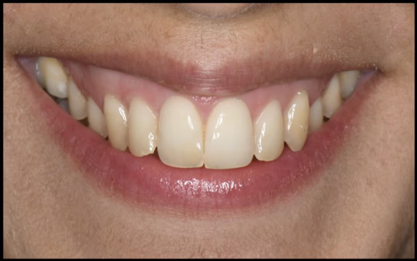 Avant / Après — après