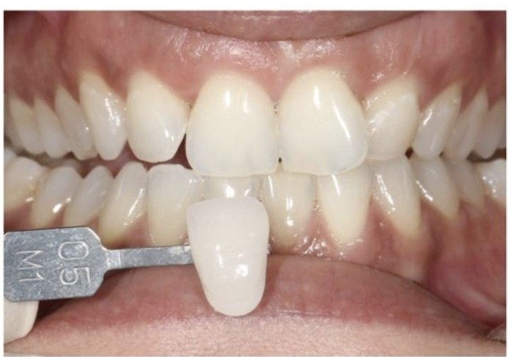 Avant / Après — avant