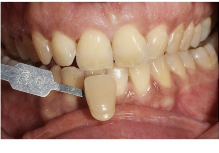 Avant / Après — après