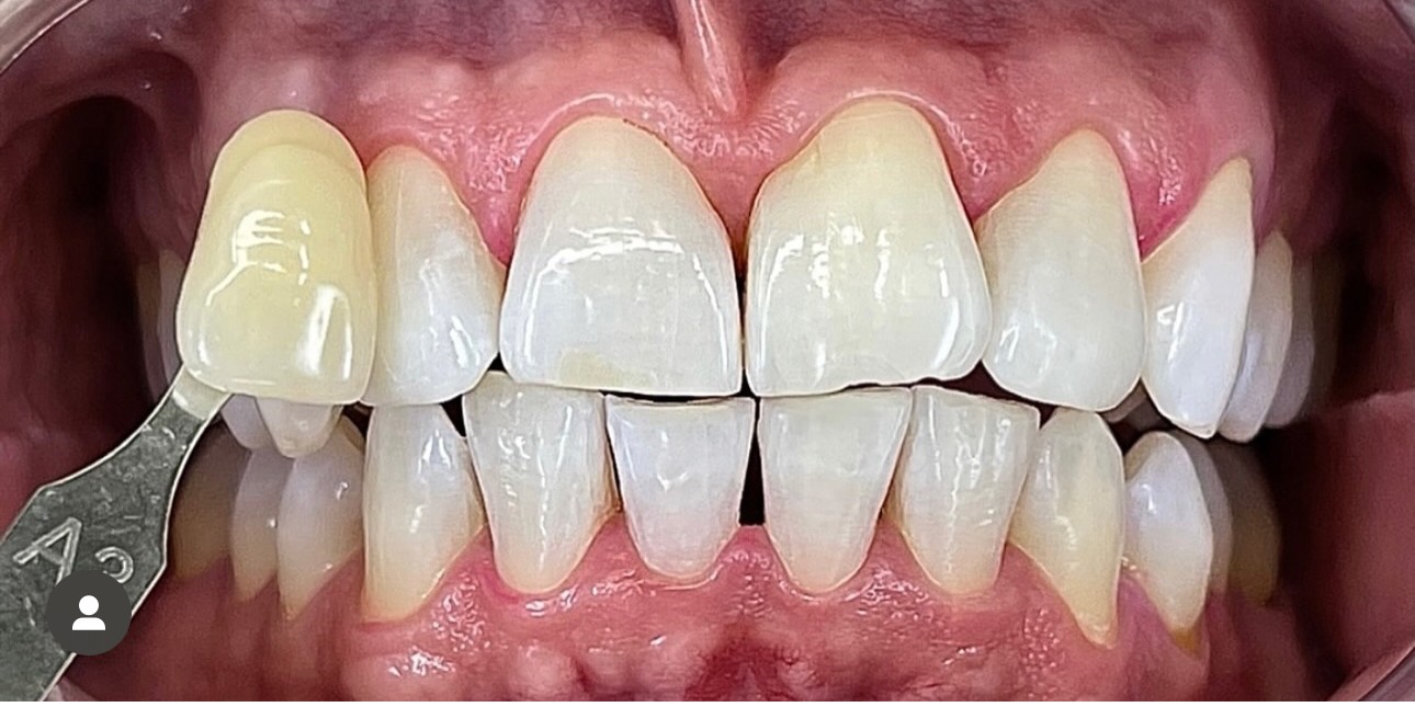 Avant / Après — avant