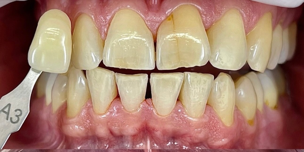 Avant / Après — après