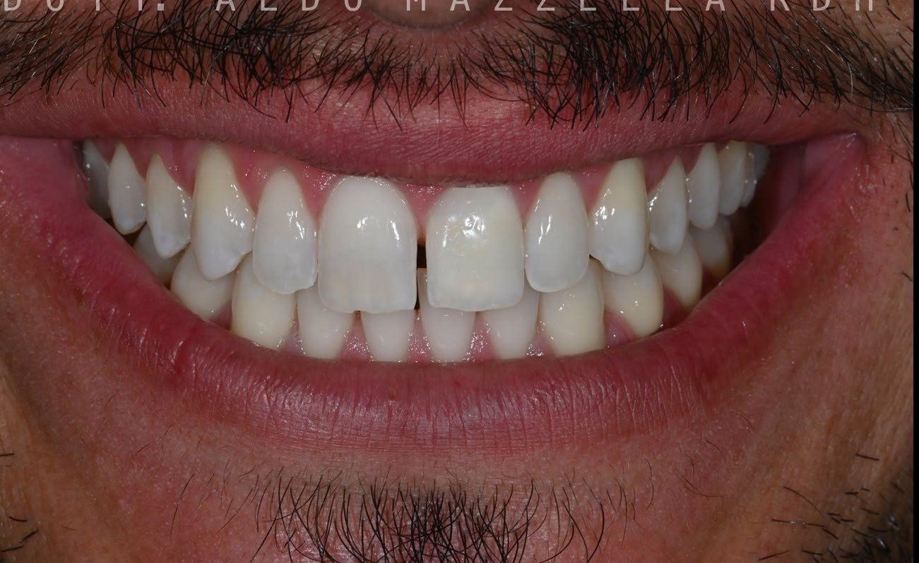 Avant / Après — avant