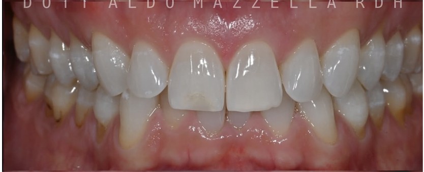 Avant / Après — avant