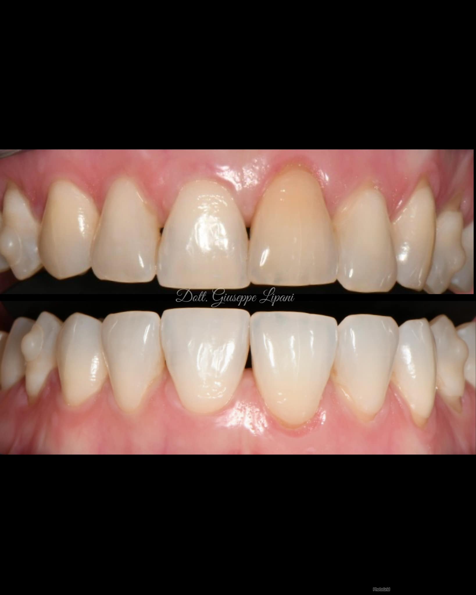 Comparaison avant/après — sourire