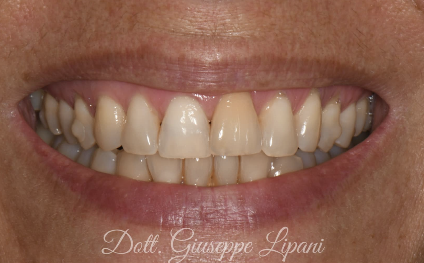 Situation initiale — patient 51 ans, taquets orthodontiques en place, dyschromie — Dr Giuseppe Lipani