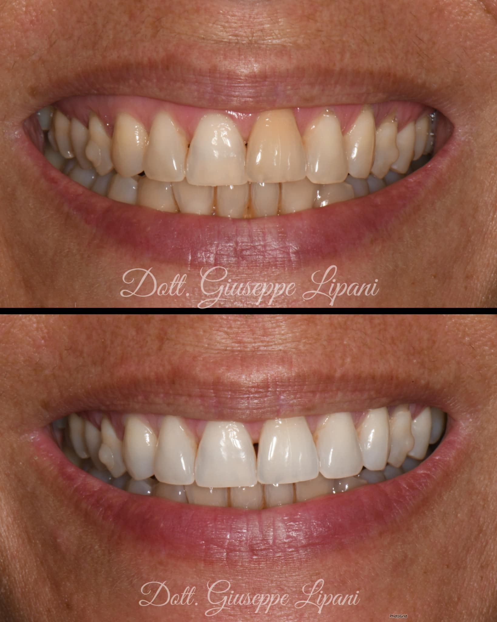 Résultat final — sourire lumineux, homogène, taquets déposés — Dr Giuseppe Lipani