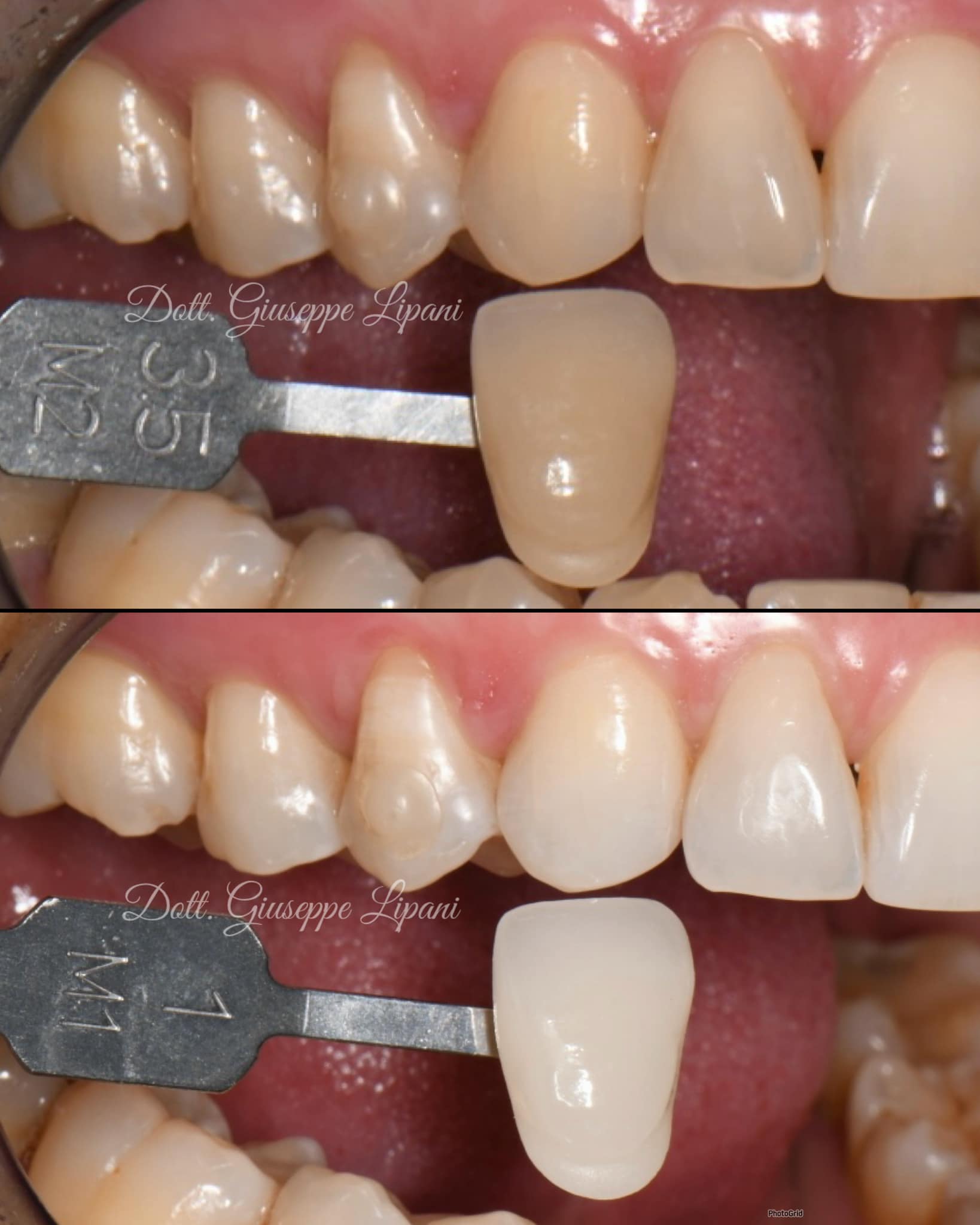 Teintier initial N3 / M1 — vue latérale — Dr Giuseppe Lipani