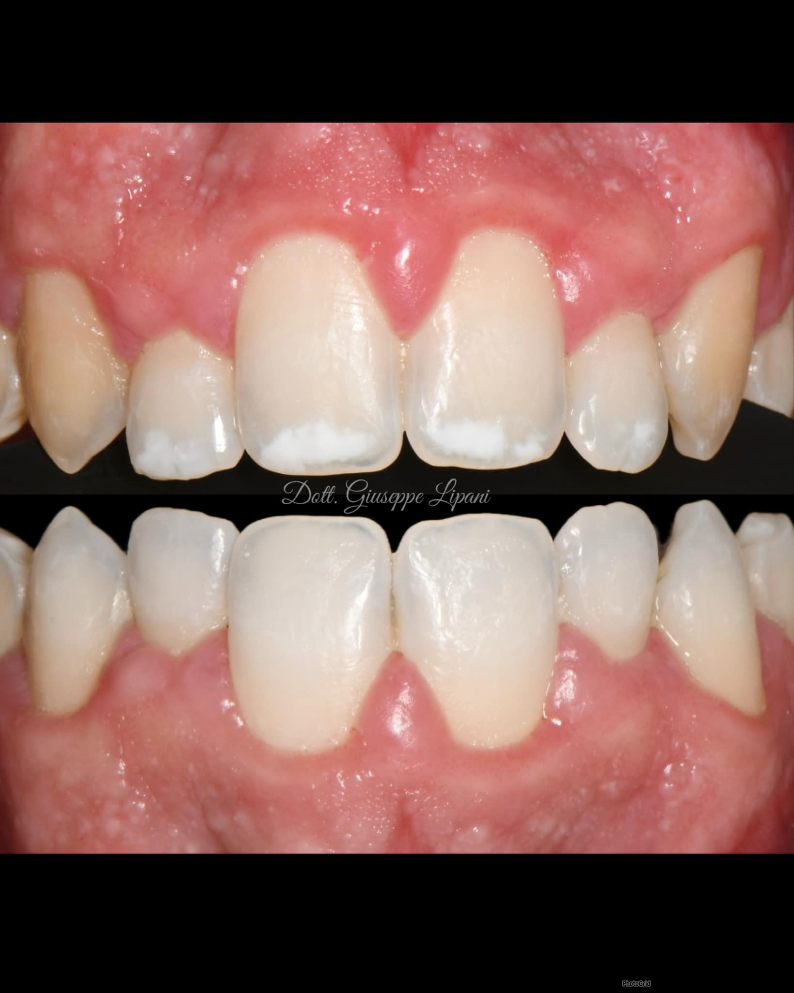 Vue latérale avant/après — gain de luminosité documenté sur les canines — Dr Giuseppe Lipani