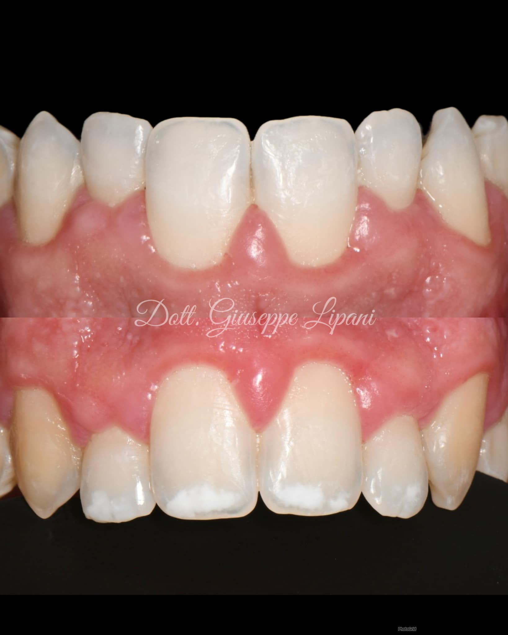 Résultat final frontal — émail homogène, zéro fraise — Dr Giuseppe Lipani