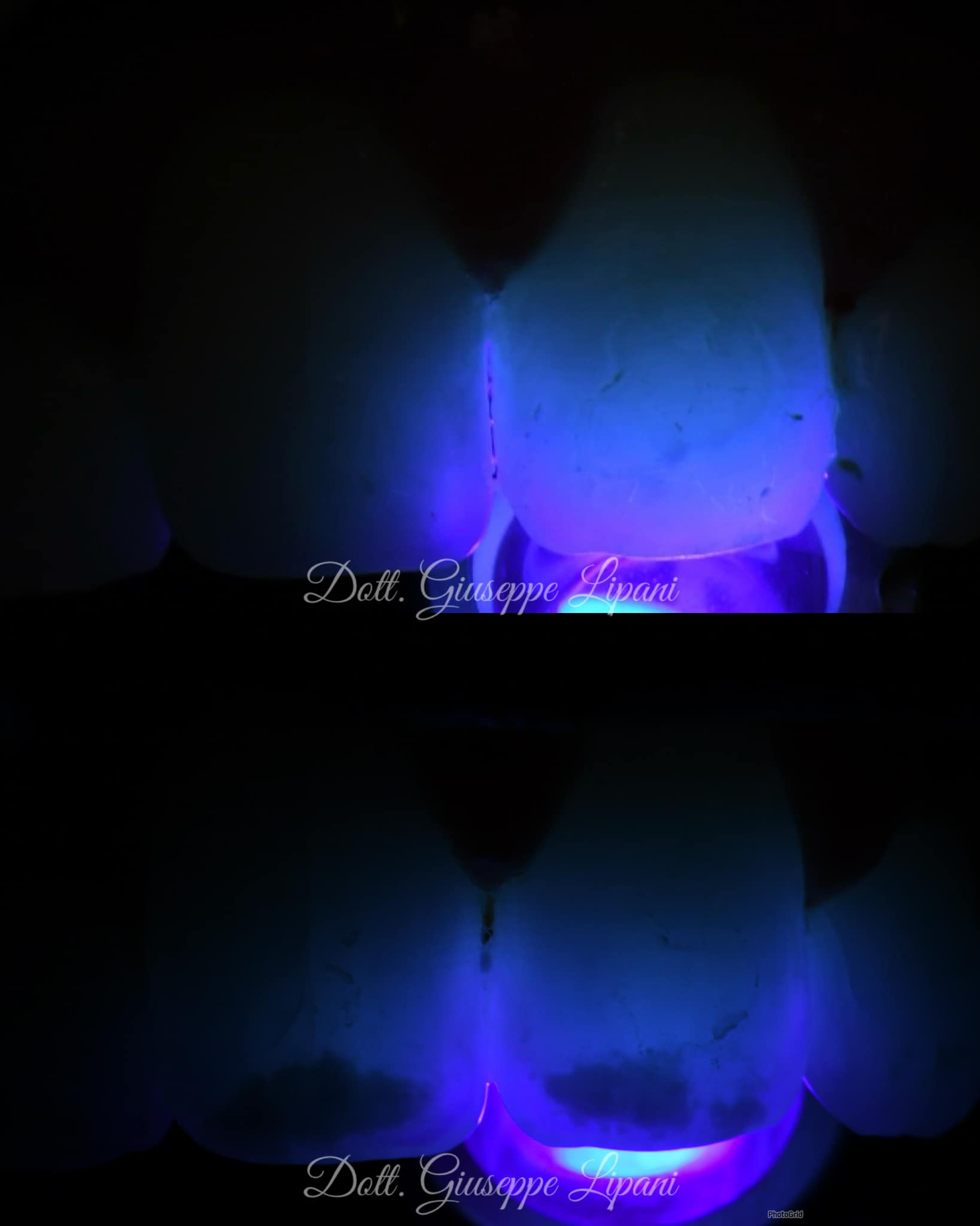 Transillumination — cartographie du défaut amélaire