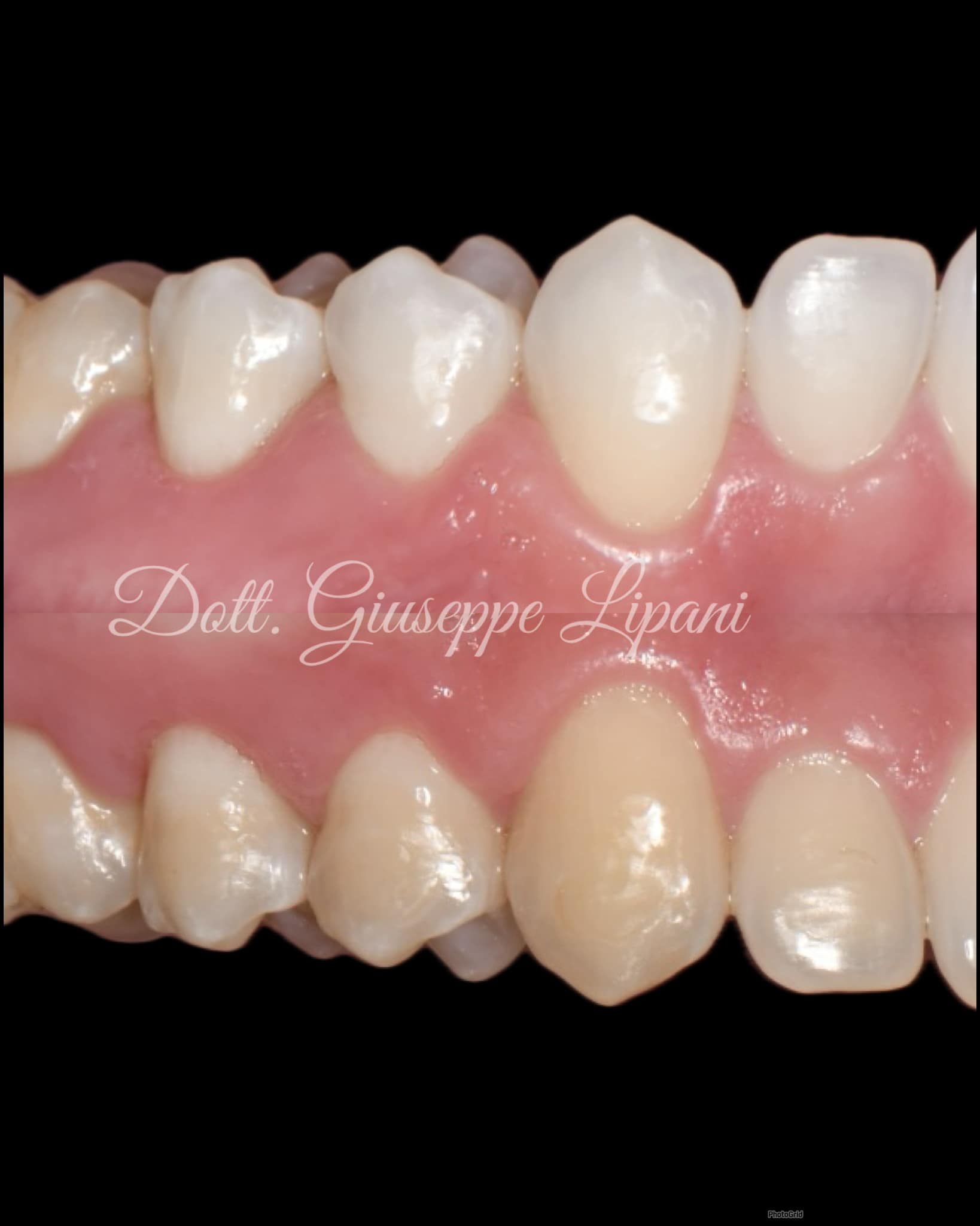 Patient B — vue frontale BlancOne HOME+ (fond noir) — Dr Giuseppe Lipani