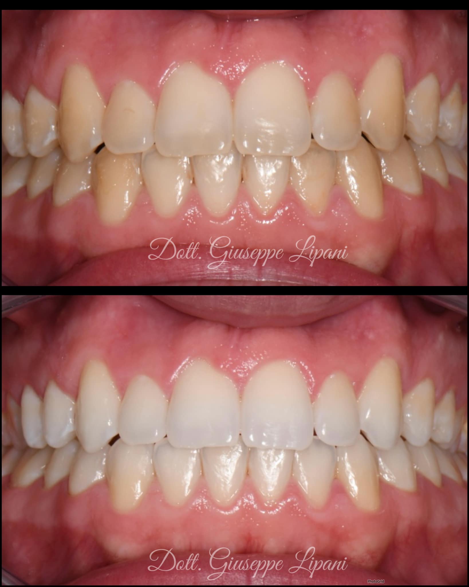 Patient B — sourire avant/après BlancOne HOME+