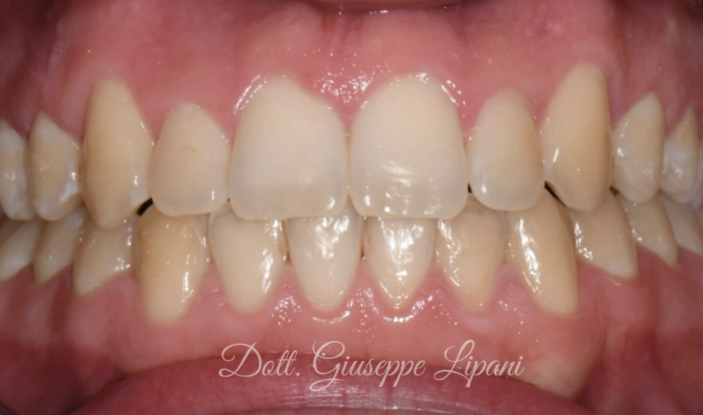 Résultat Patient B — BlancOne HOME+ EVER + NIGHT — Dr Giuseppe Lipani