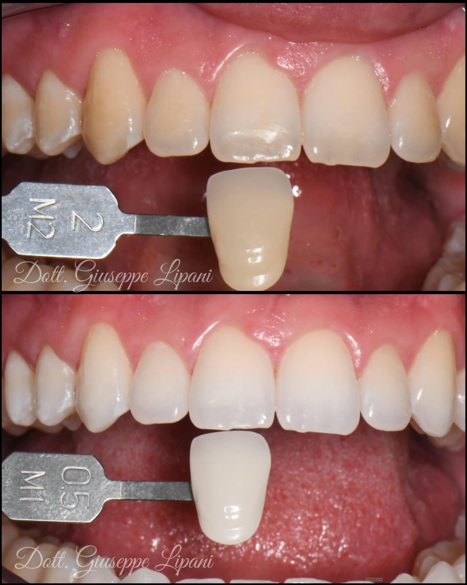 Patient B — teintier incisives 2M2 → 0.5M1 — Dr Giuseppe Lipani