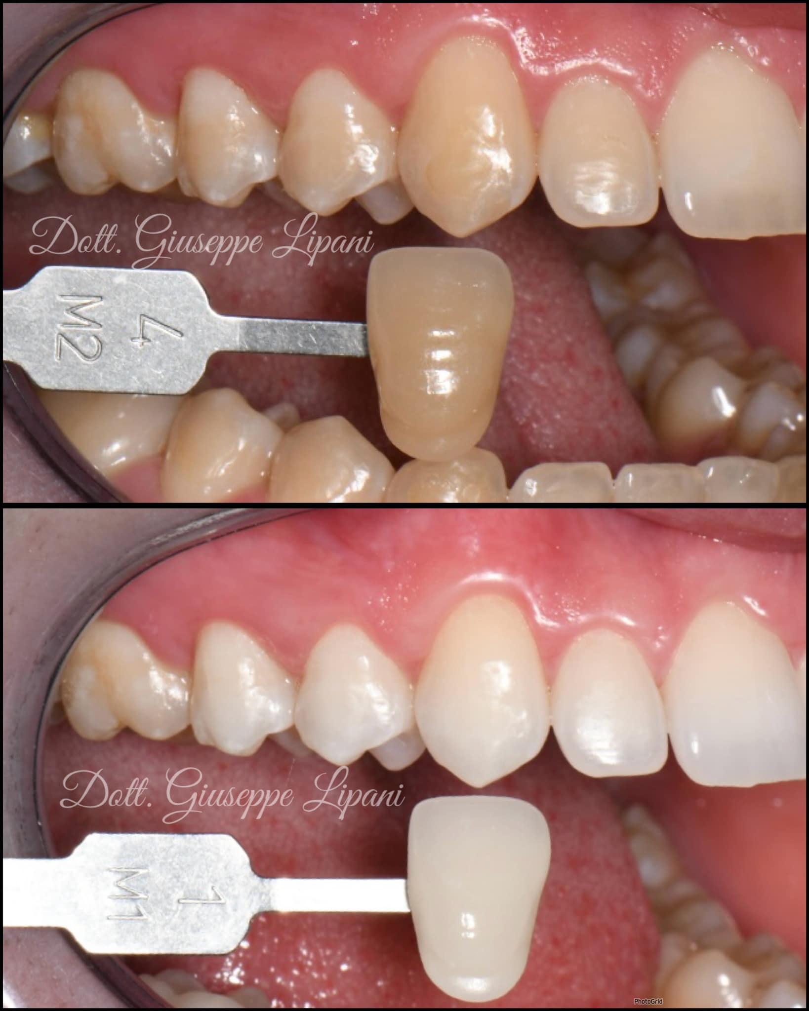 Patient B — teintier latéral canine 4M2 → 1M1 — Dr Giuseppe Lipani