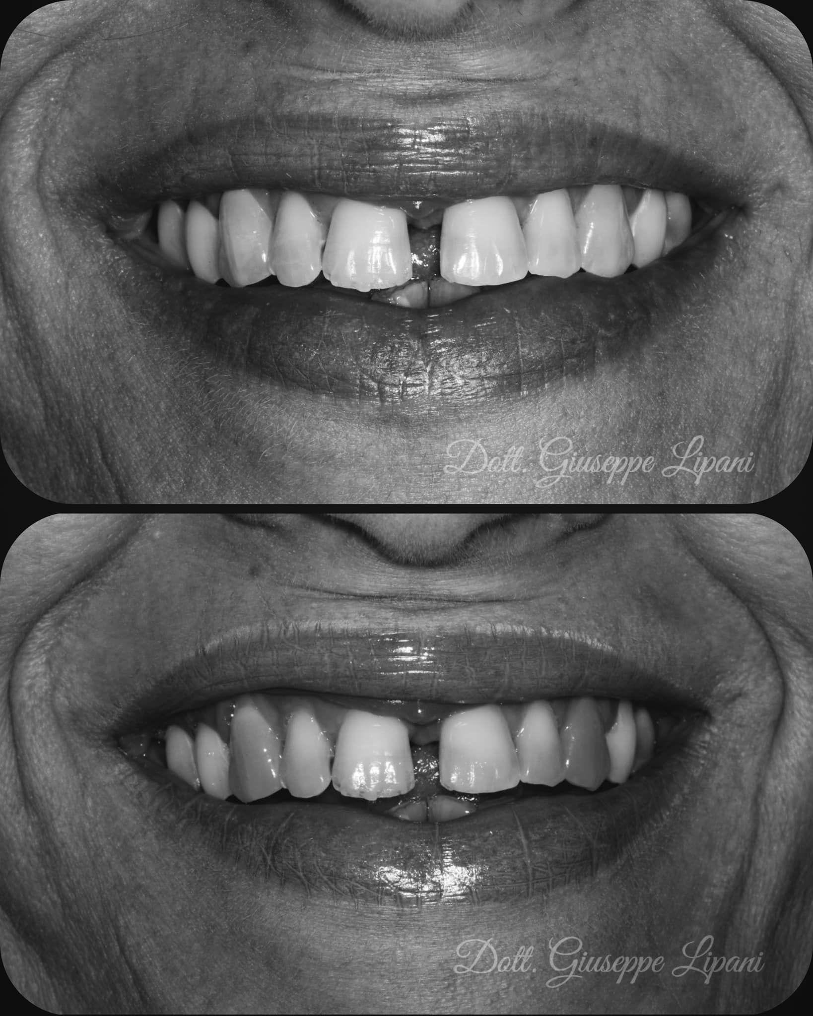 Avant/après en noir et blanc — différence de luminosité visible — Dr Giuseppe Lipani