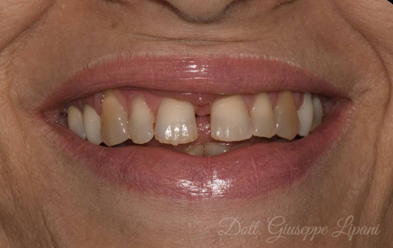 Situation initiale — dyschromie dents naturelles vs couronnes existantes — Dr Giuseppe Lipani