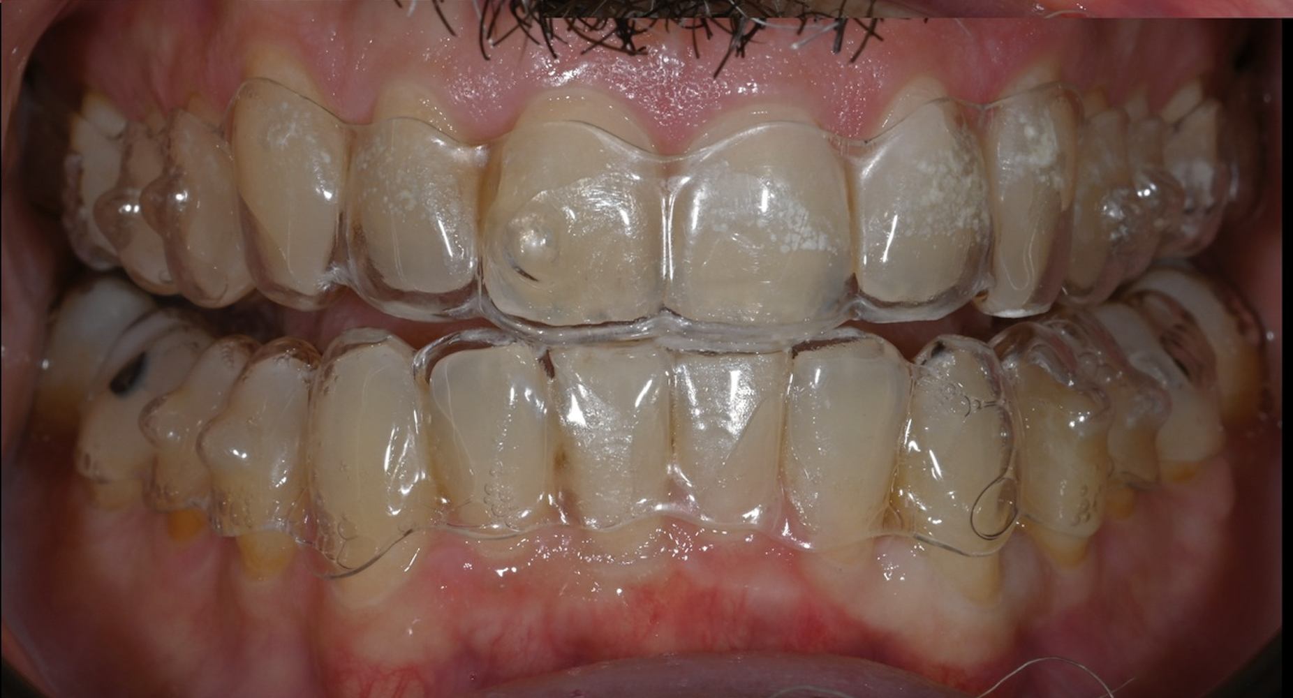 Aligneur avec gel BlancOne Ever CP 7% en place — Dr Aldo Mazzella