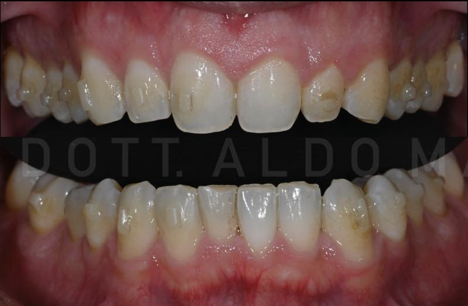 Situation initiale — Traitement combiné aligneurs + BlancOne Ever — Dr Aldo & Maurizio Mazzella