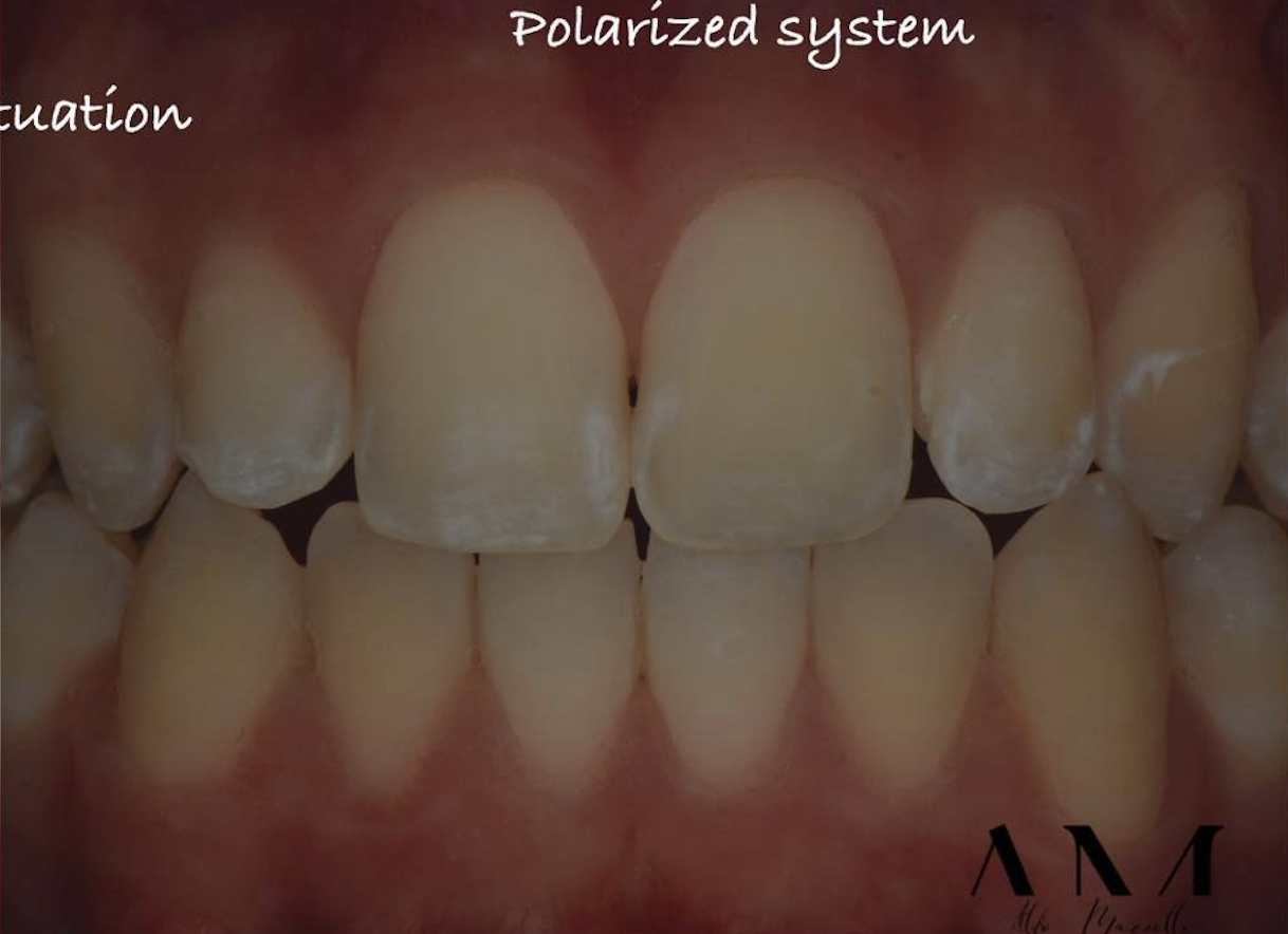 Situation initiale — WSL post-orthodontiques sous filtre polarisé — Dr Aldo Mazzella