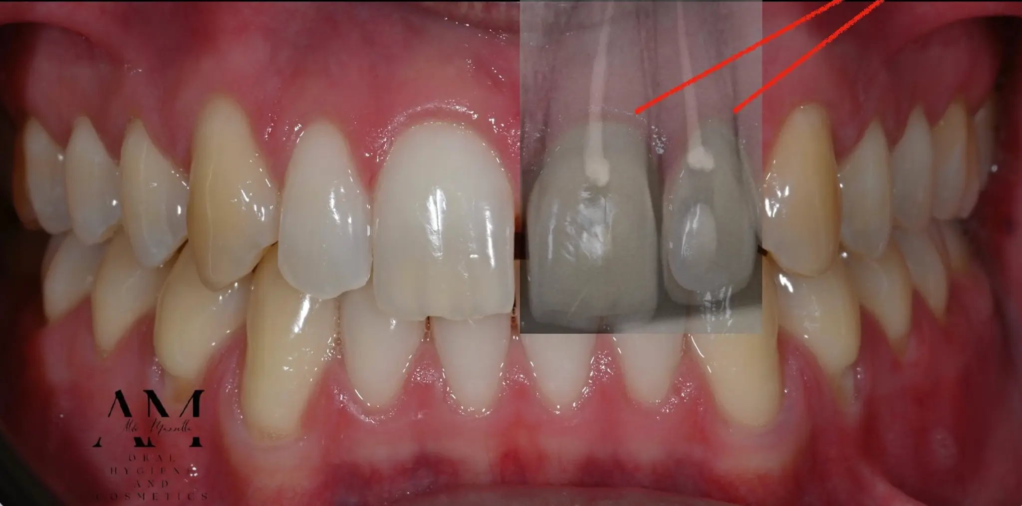 Dent non vitale post-traumatique — vue clinique avec radiographie — Dr Aldo Mazzella