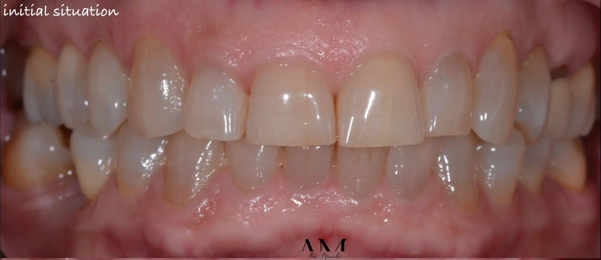 Situation initiale — dyschromies tétracyclines — Dr Aldo Mazzella