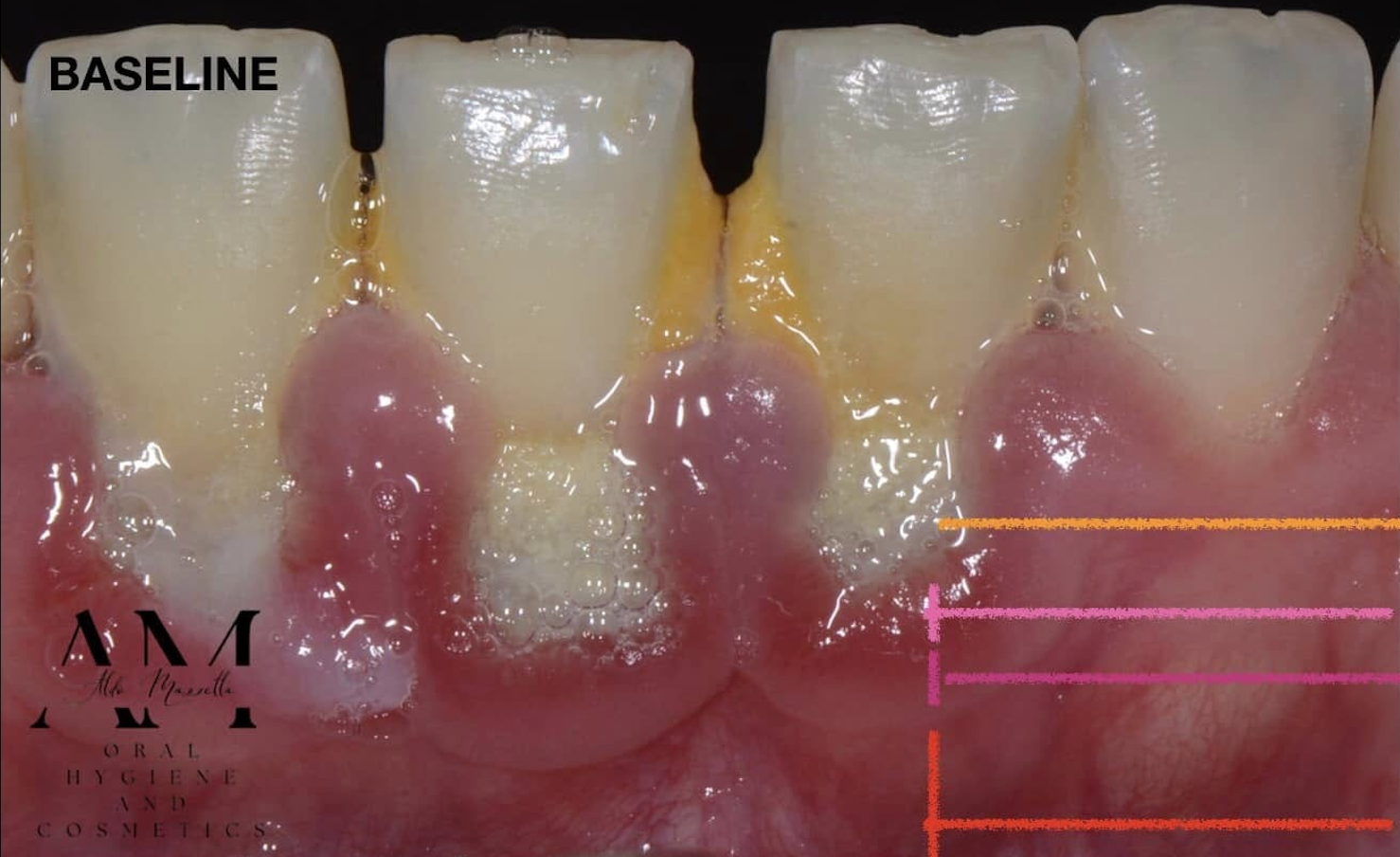 Baseline — biofilm bactérien, inflammation gingivale, biotype gingival fin — Dr Aldo Mazzella