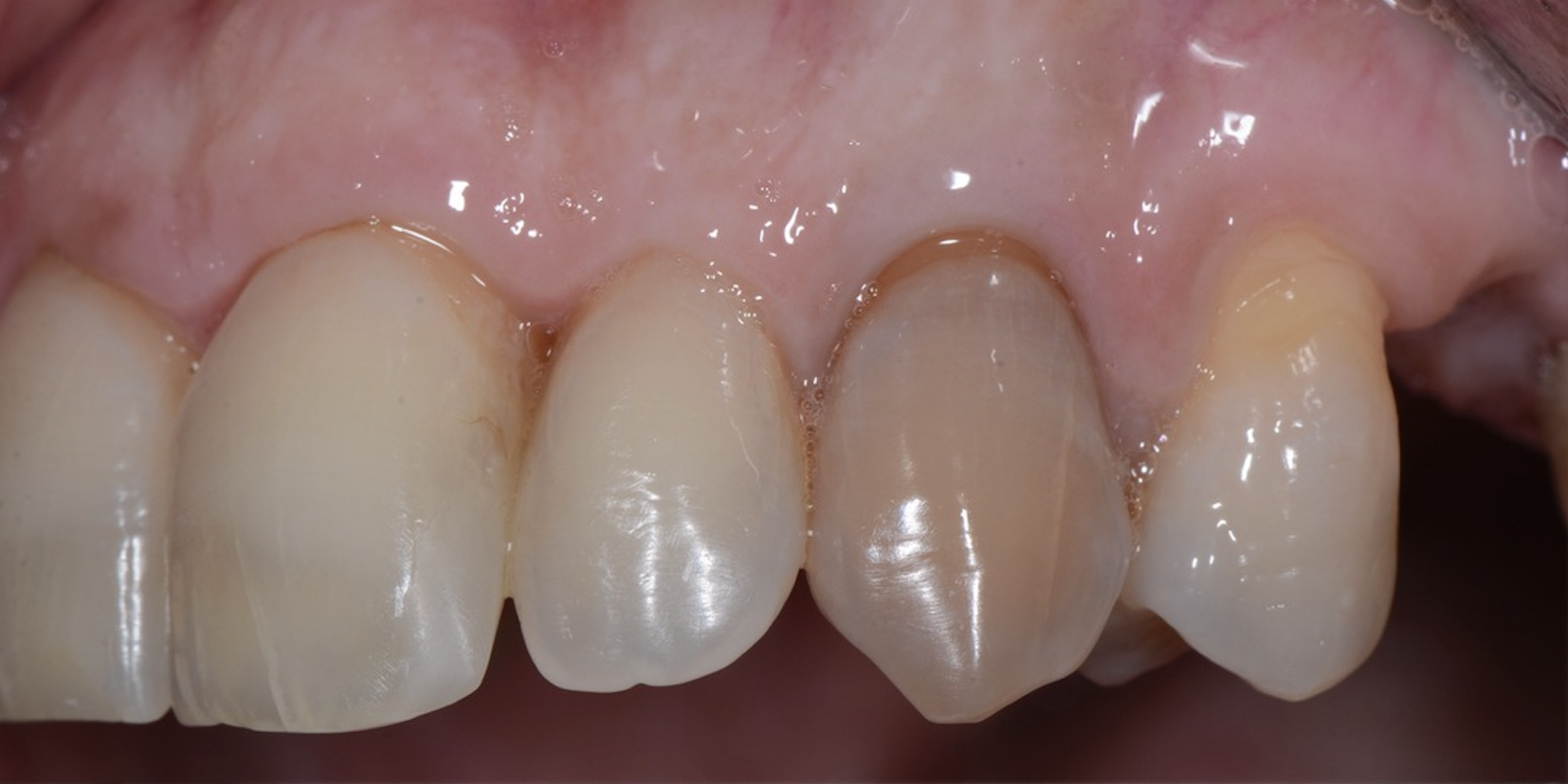 Situation initiale — Dent 23 dépulpée, dischromatose — Dr Aldo Mazzella