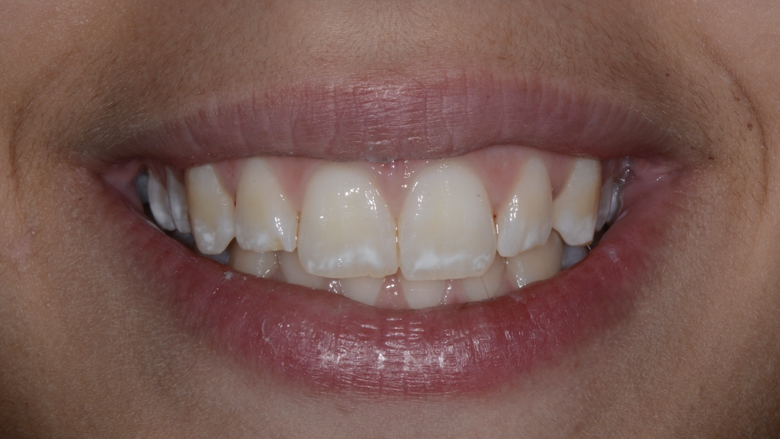 Fluorose TF2 — Vue sourire baseline — Macules d'hypominéralisation émail — Zone vésuvienne — Dr Aldo Mazzella