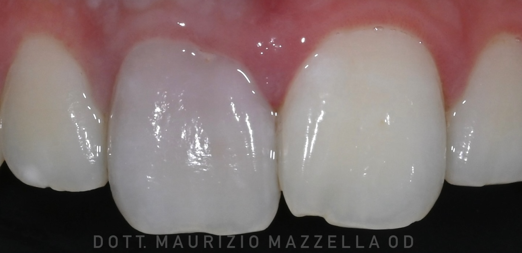 Walking Bleaching — patient 16 ans, dents 1.1 et 2.1