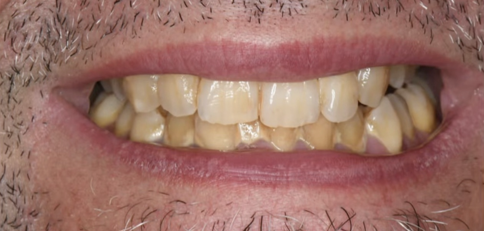 Prophylaxie et maintenance esthétique — après