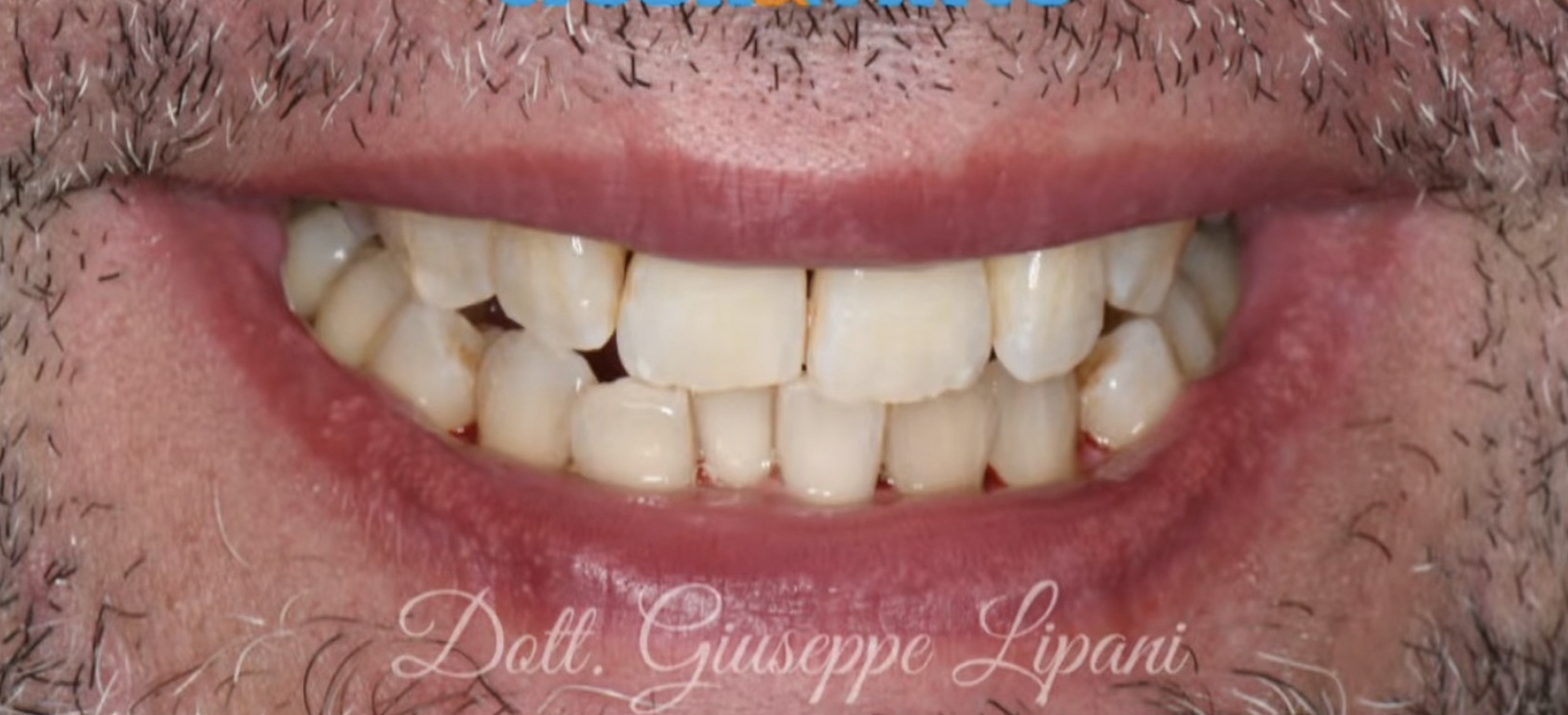 Prophylaxie et maintenance esthétique — avant